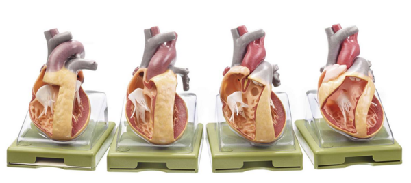 Modellserie mit Darstellung angeborener Herzfehler